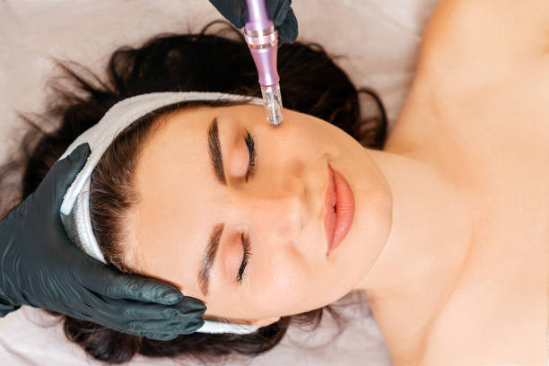 A woman receiving a microneedling facial treatment at a spa.