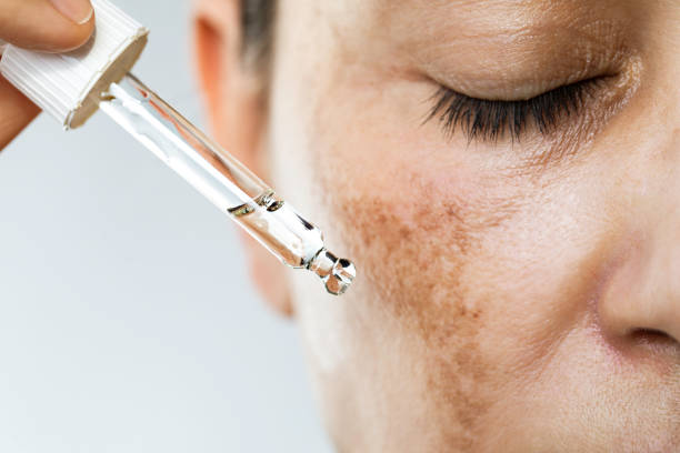 Close-up of a woman applying facial serum to treat skin pigmentation